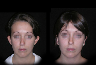 Otoplastica
