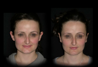 Otoplastica