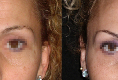 Botox