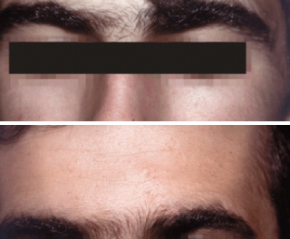 Inestetismi Cutanei