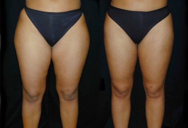 Liposcultura