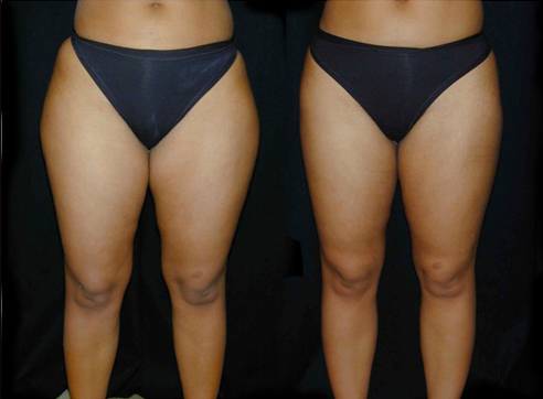 Liposcultura