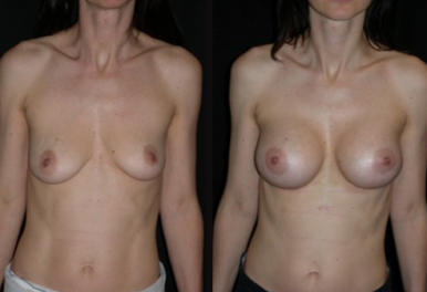 Mastoplastica Additiva Trans-Ascellare